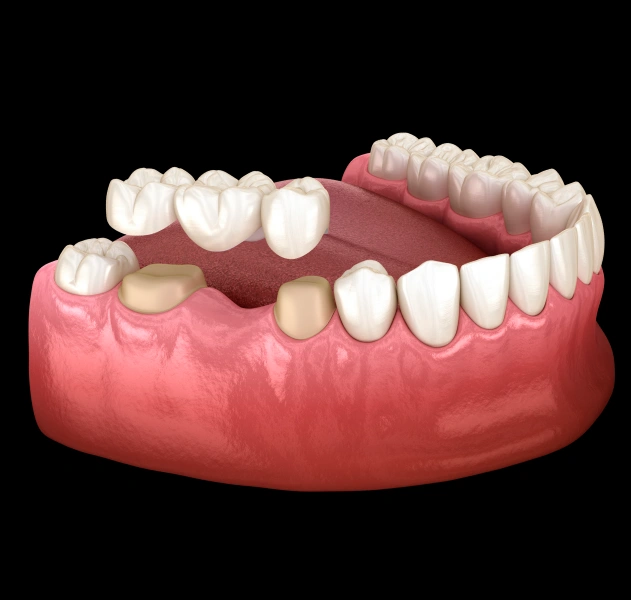 Dental bridge restoration for missing teeth