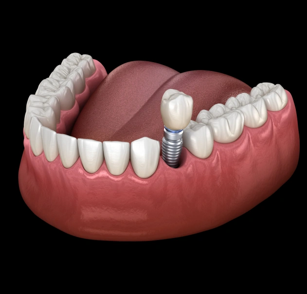 Dental implant treatment for permanent tooth replacement