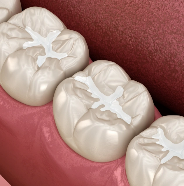 Dental sealant treatment on molars