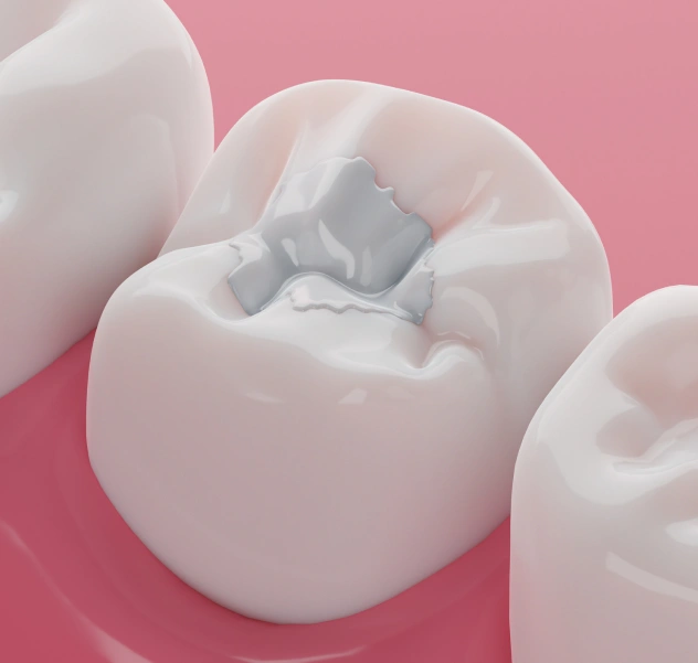 Tooth-colored dental filling for cavity treatment